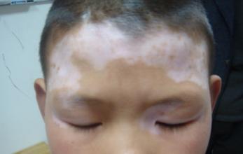 儿童脸部患上白癜风的原因是什么