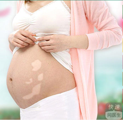 孕妇白癜风患者的早期症状有哪些